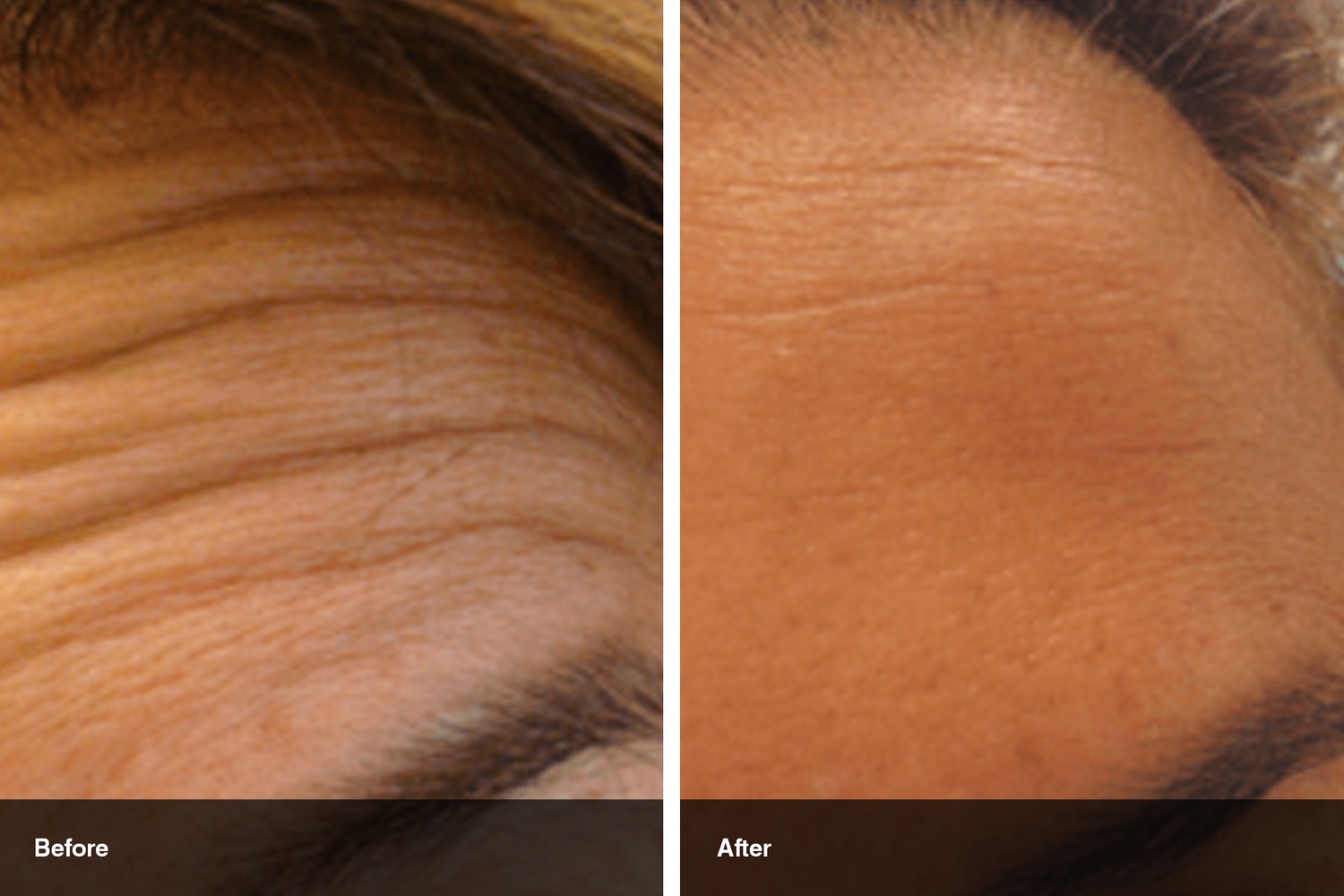 dermal fillers botox neuromodulators before after midwest vein and laser dayton 0