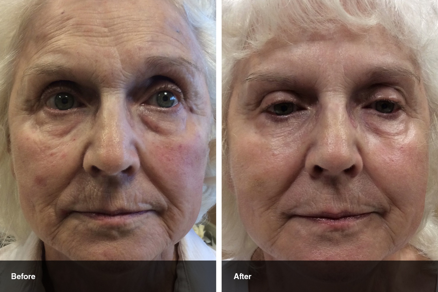 dermal fillers botox neuromodulators before after midwest vein and laser dayton 1