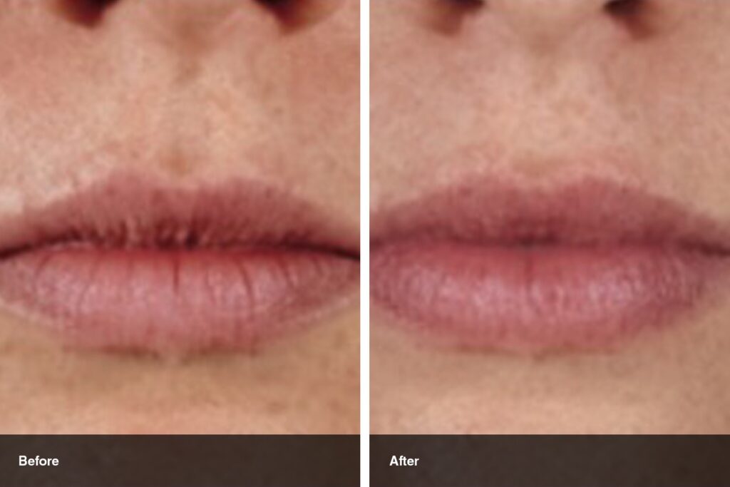 lip filler