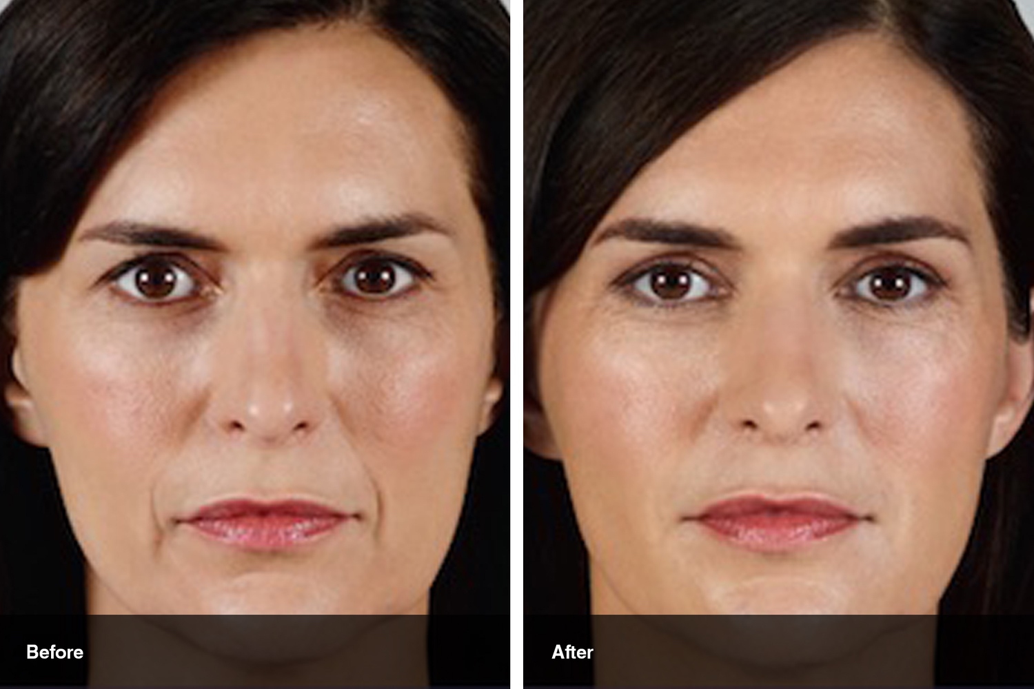 dermal fillers botox neuromodulators before after midwest vein and laser dayton 11