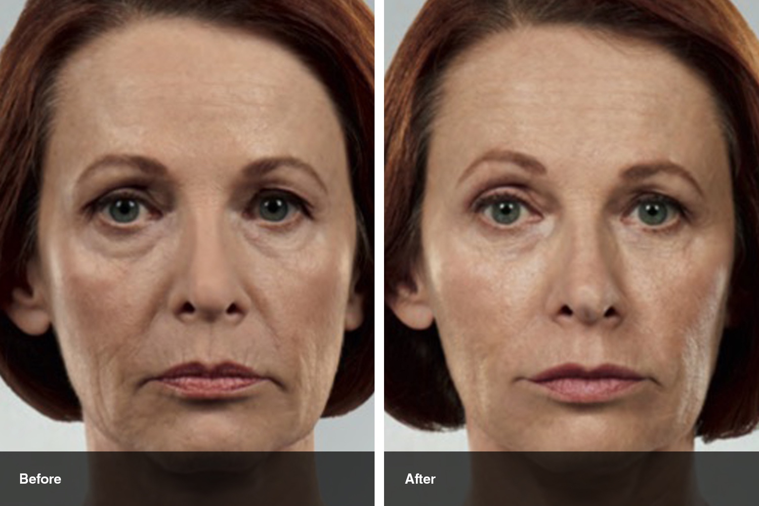 dermal fillers botox neuromodulators before after midwest vein and laser dayton 12