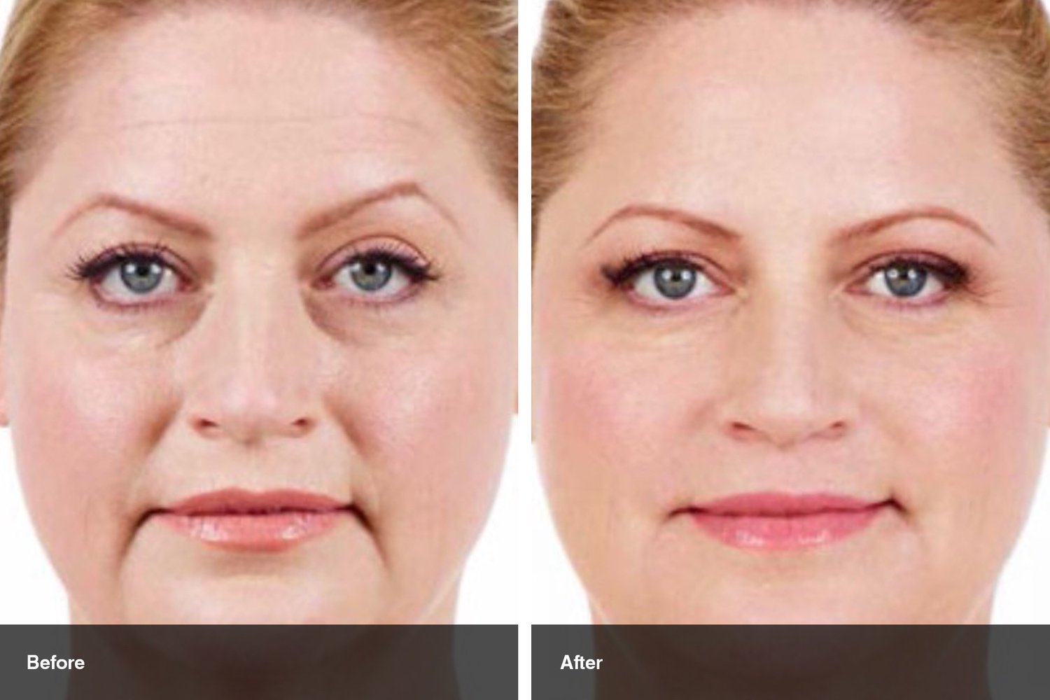 dermal fillers botox neuromodulators before after midwest vein and laser dayton 14