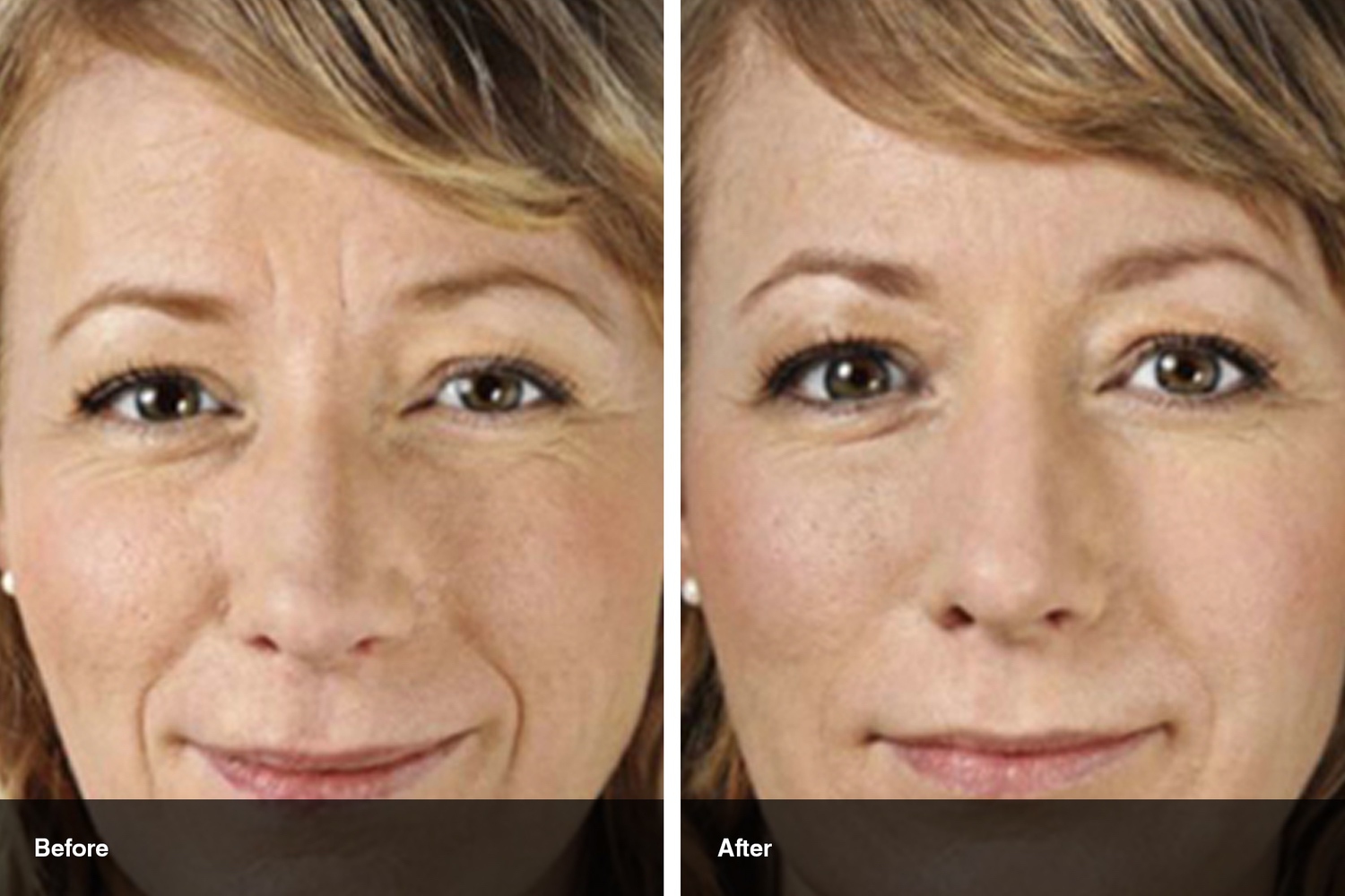 dermal fillers botox neuromodulators before after midwest vein and laser dayton 15