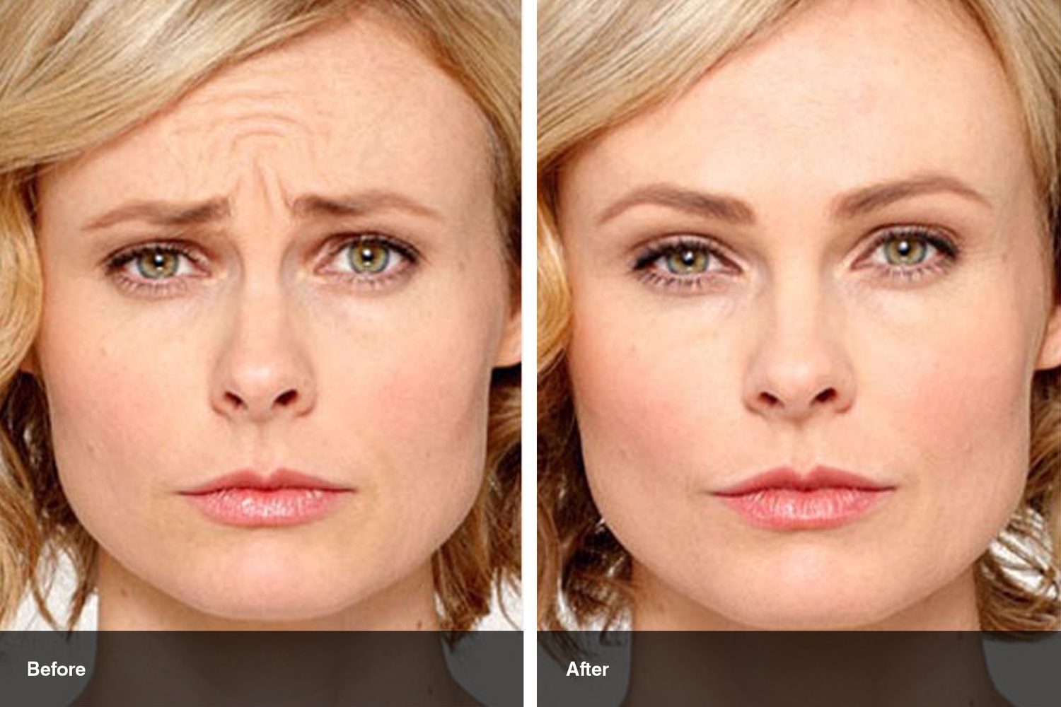 dermal fillers botox neuromodulators before after midwest vein and laser dayton 2
