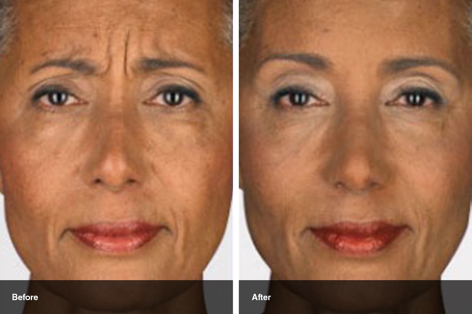 dermal fillers botox neuromodulators before after midwest vein and laser dayton 3