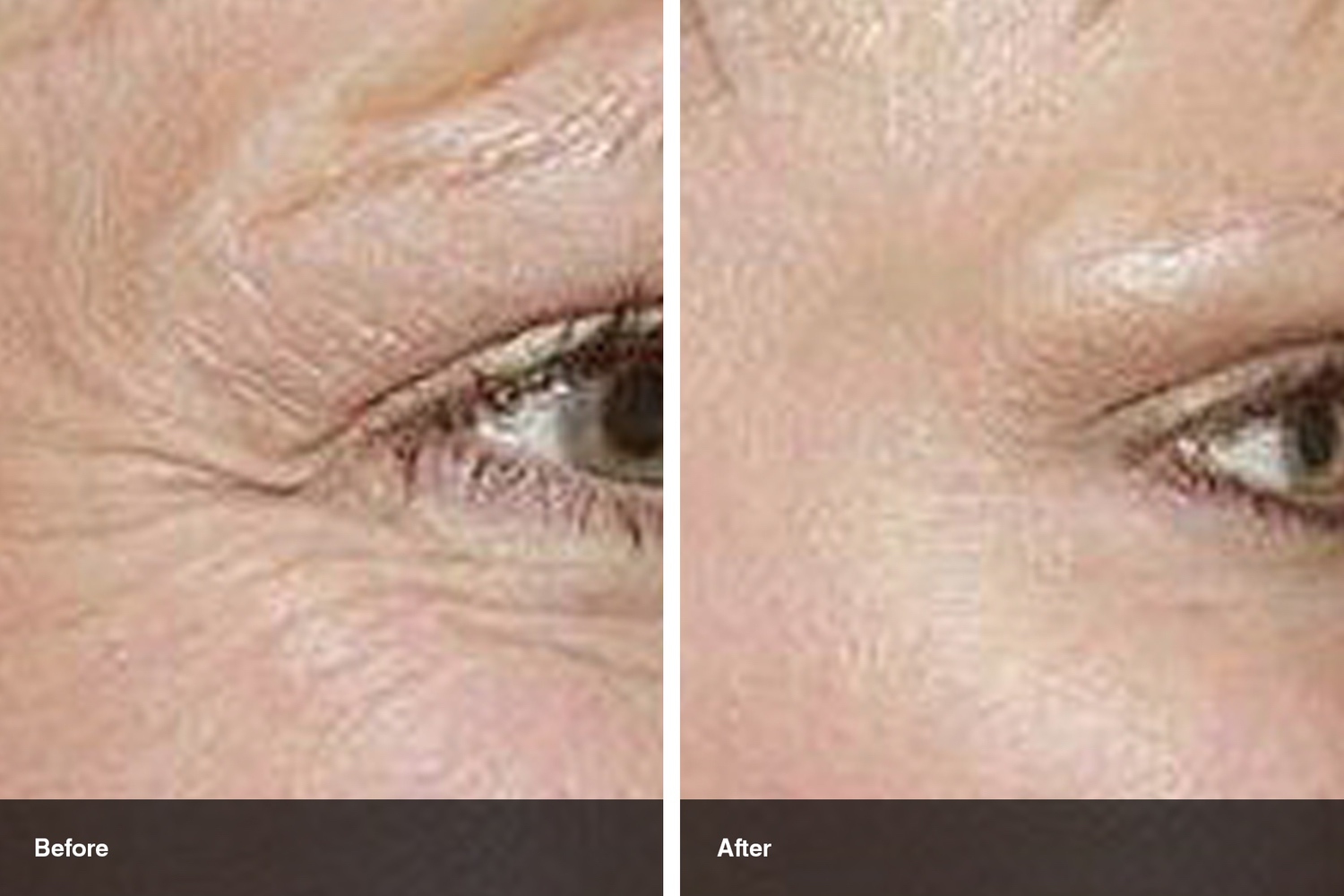 dermal fillers botox neuromodulators before after midwest vein and laser dayton 5