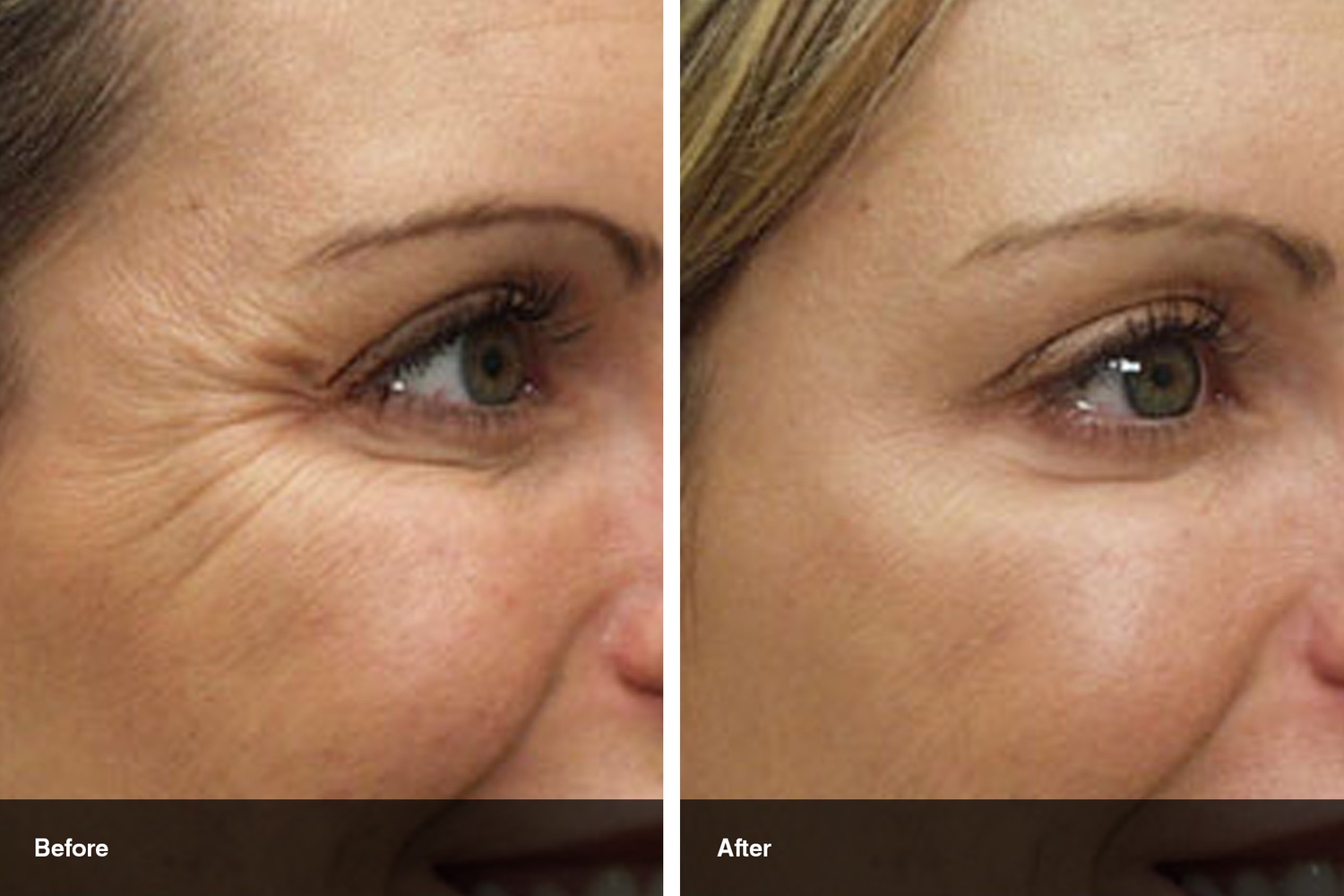 dermal fillers botox neuromodulators before after midwest vein and laser dayton 6