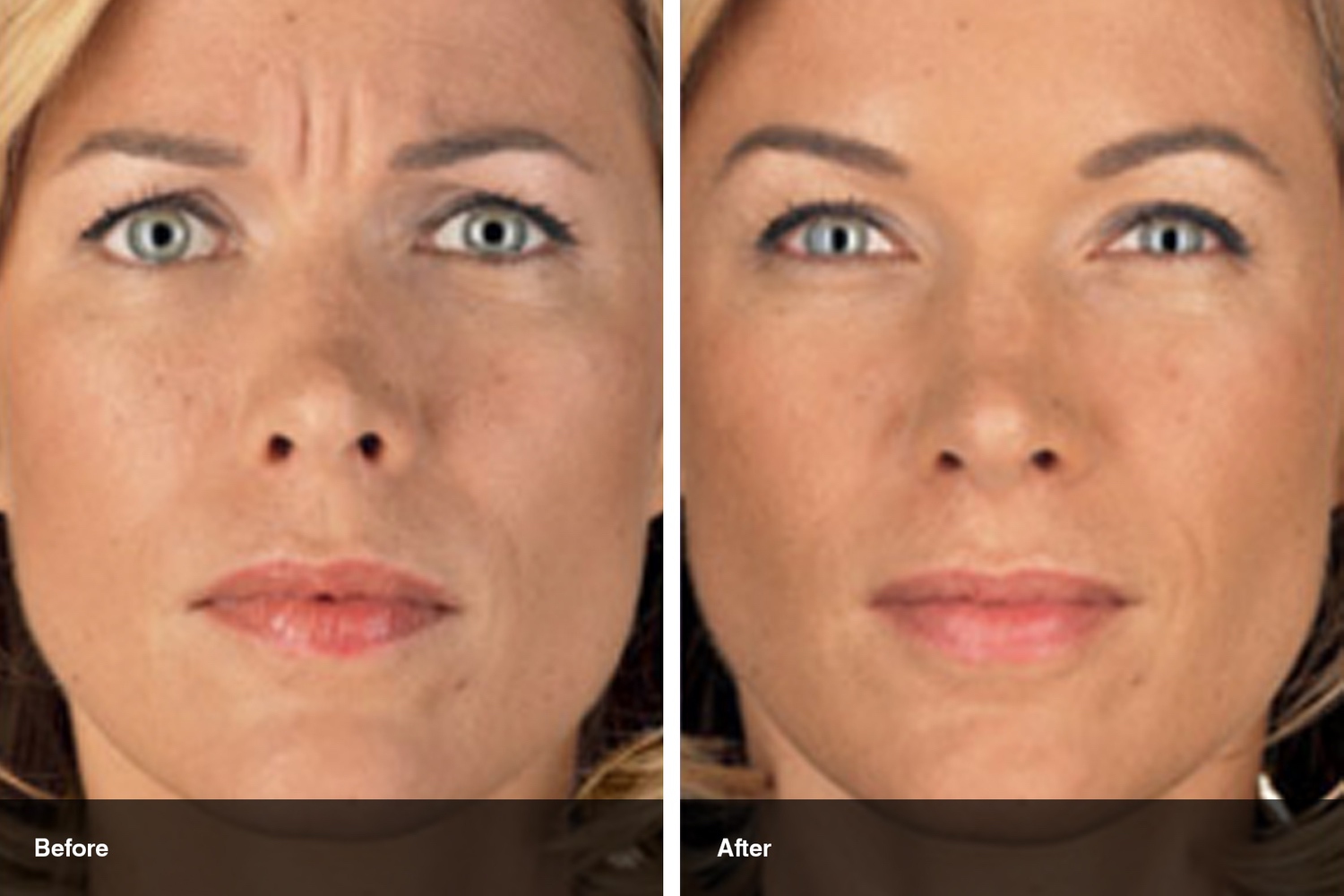 dermal fillers botox neuromodulators before after midwest vein and laser dayton 7