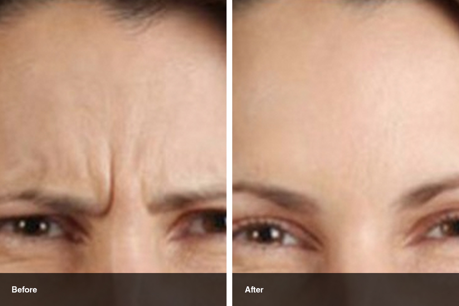 dermal fillers botox neuromodulators before after midwest vein and laser dayton 8