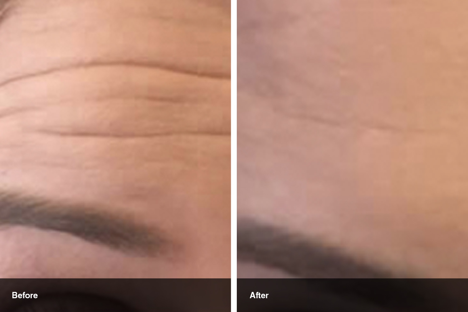 dermal fillers botox neuromodulators before after midwest vein and laser dayton 9