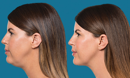 kybella-before-and-after1