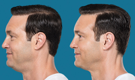 kybella-before-and-after2