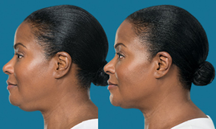 kybella-before-and-after3