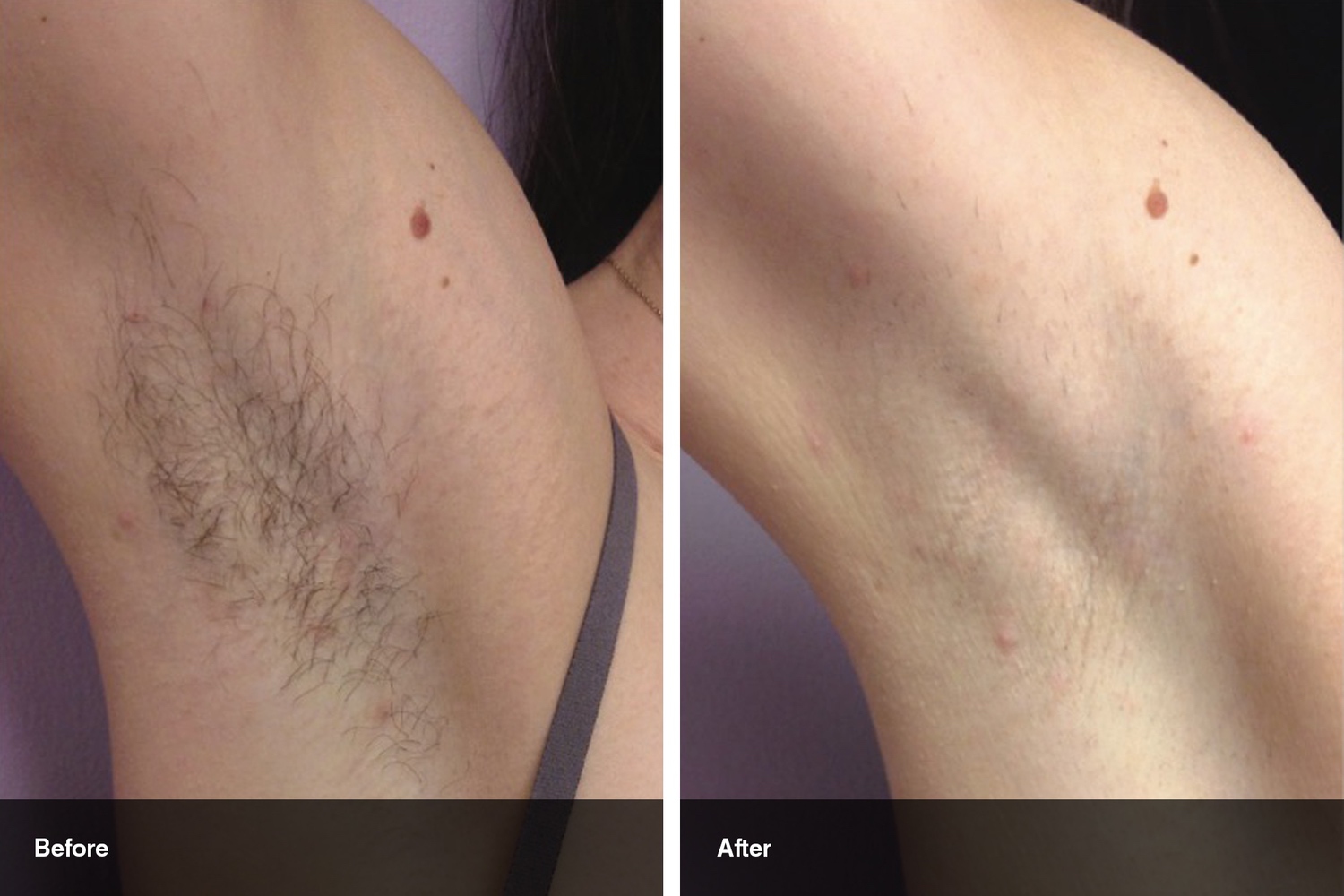 laser hair removal before after midwest vein and laser dayton 0
