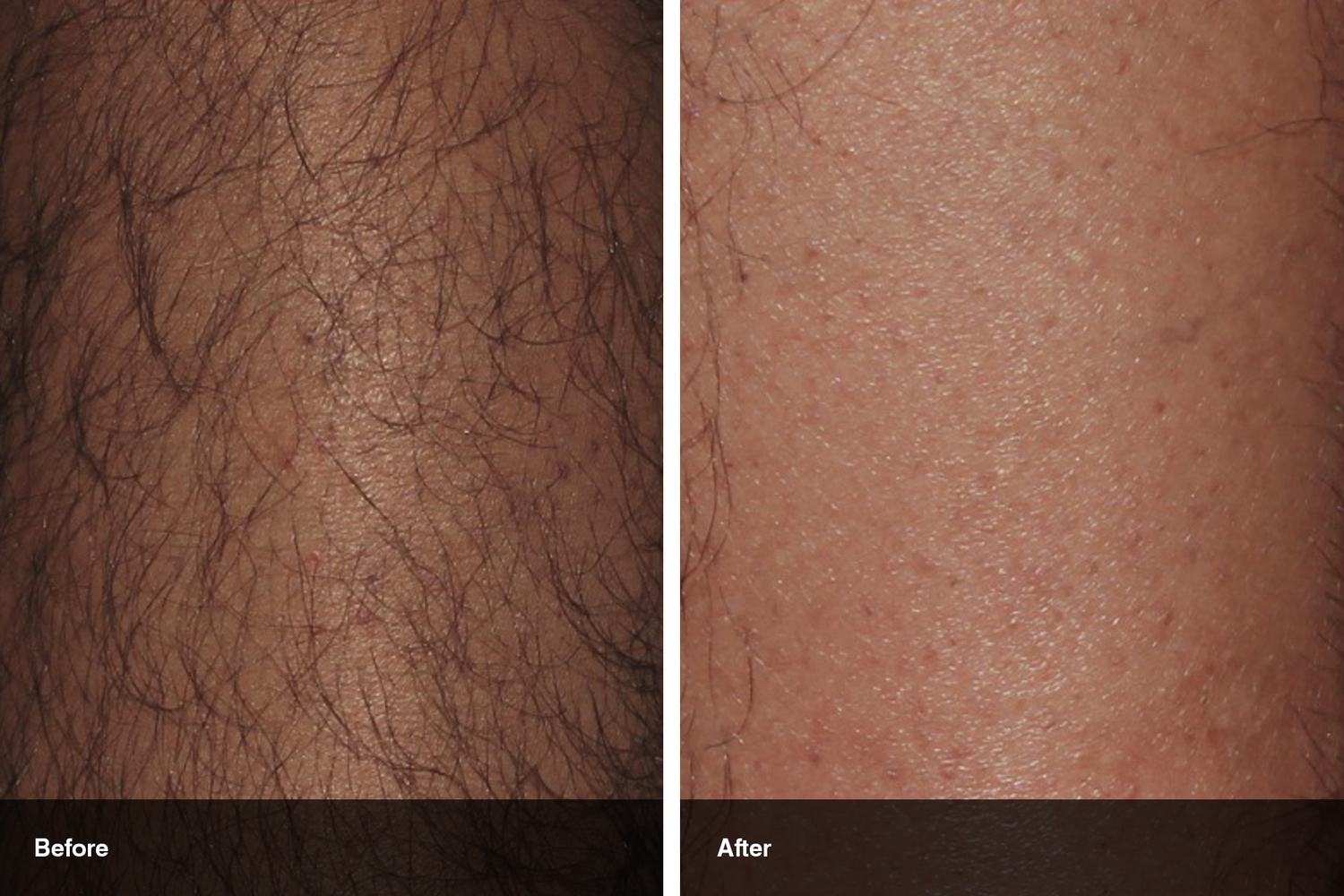 laser hair removal before after midwest vein and laser dayton 1