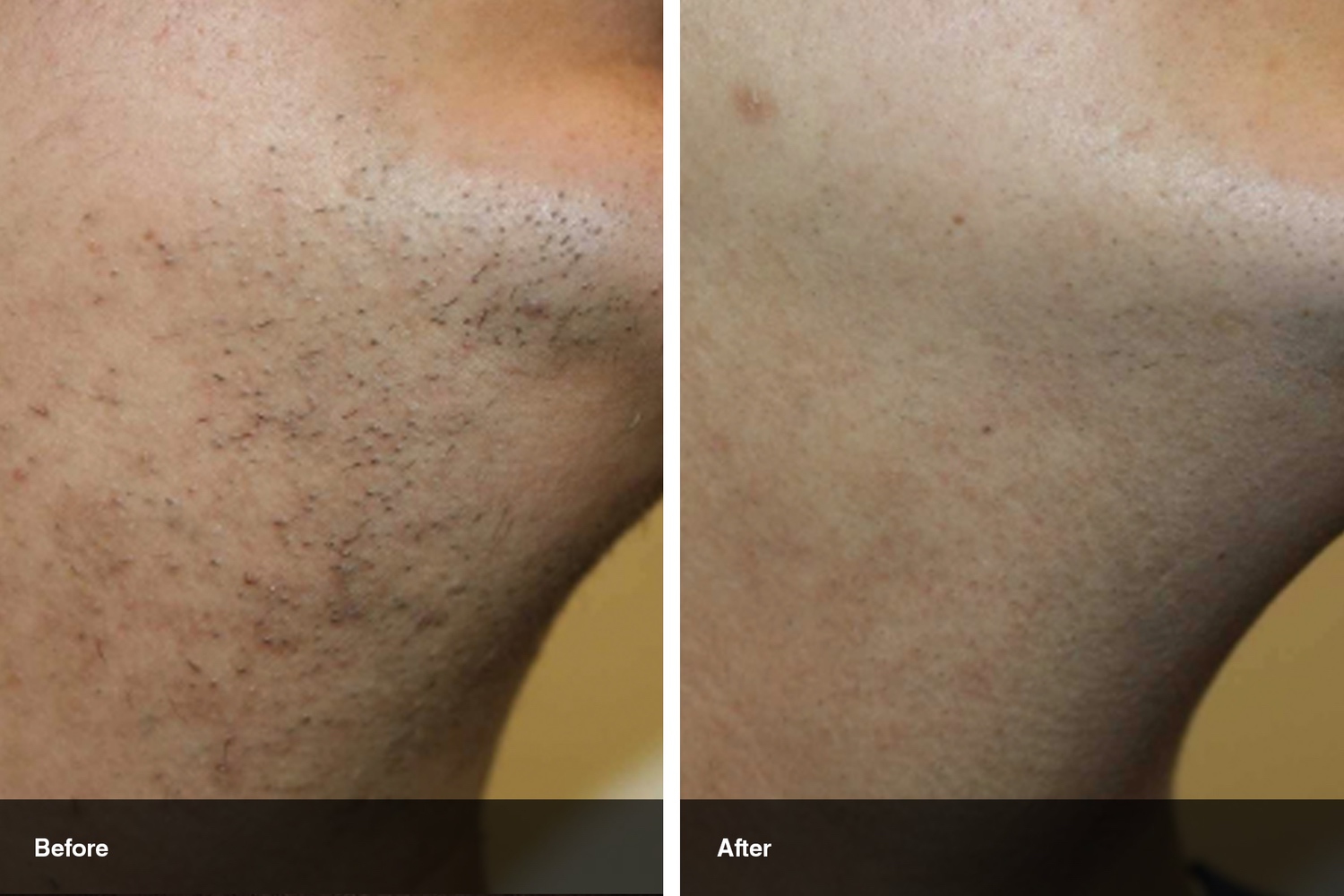 laser hair removal before after midwest vein and laser dayton 2