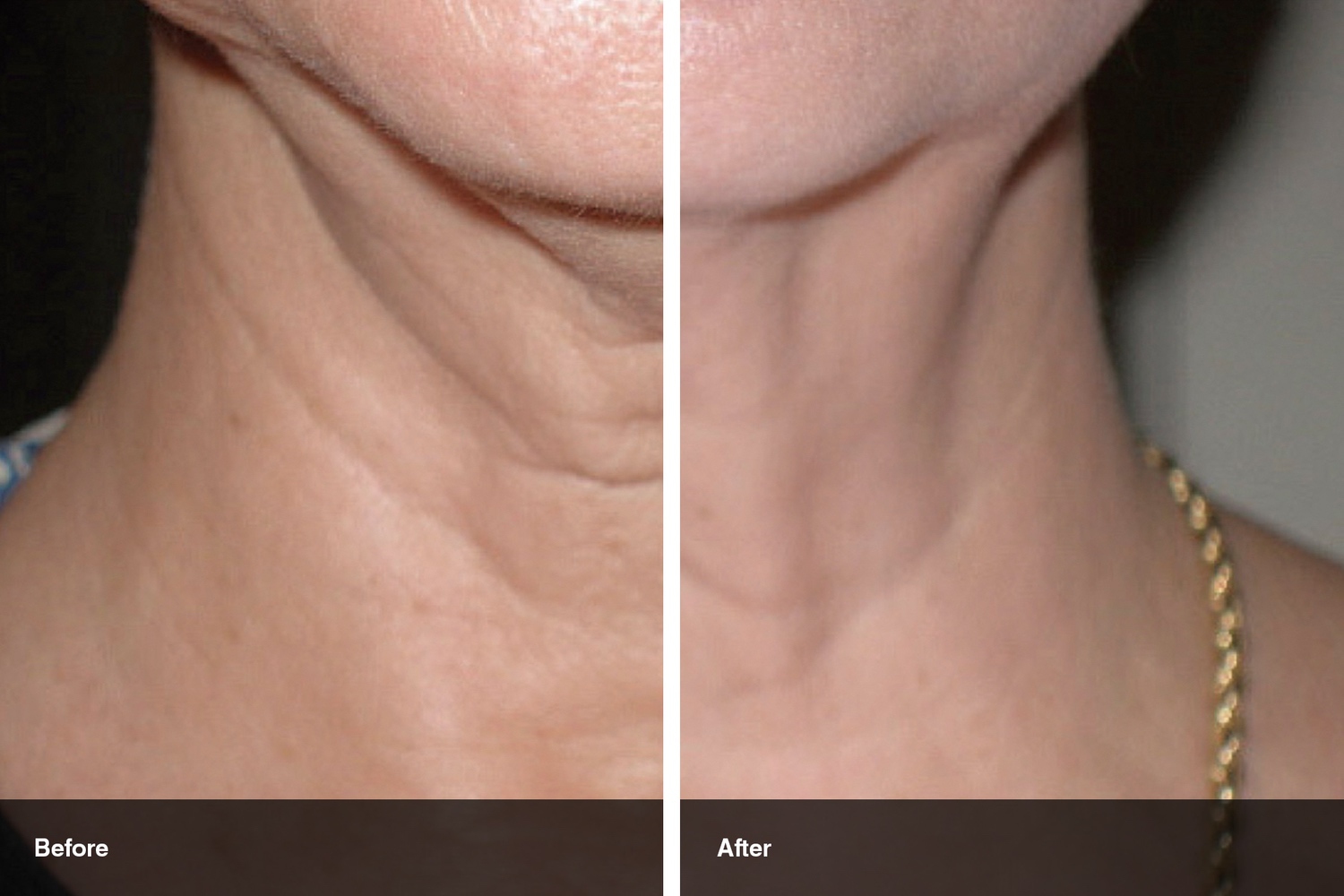 skin tyte before after midwest vein and laser dayton 0
