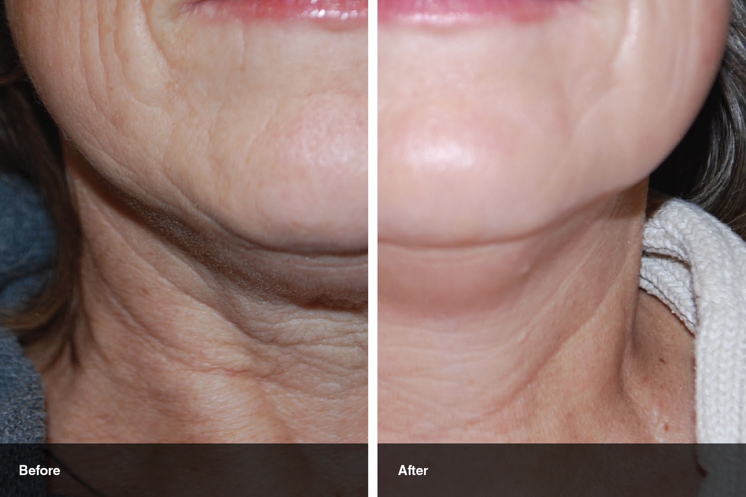 skin tyte before after midwest vein and laser dayton 1