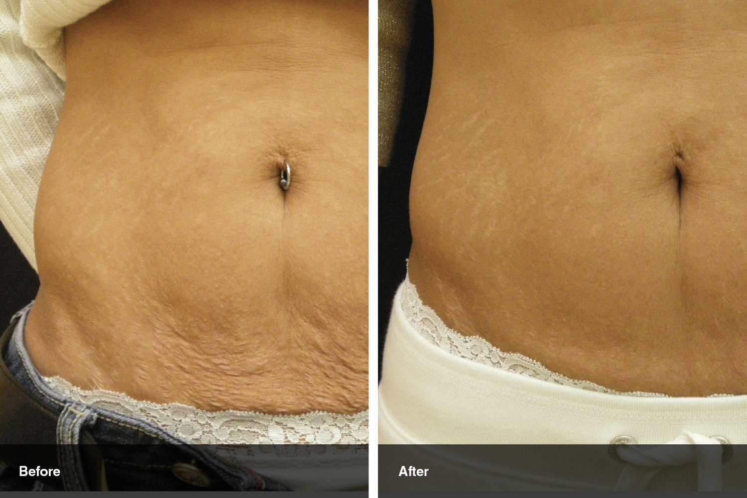skin tyte before after midwest vein and laser dayton 2