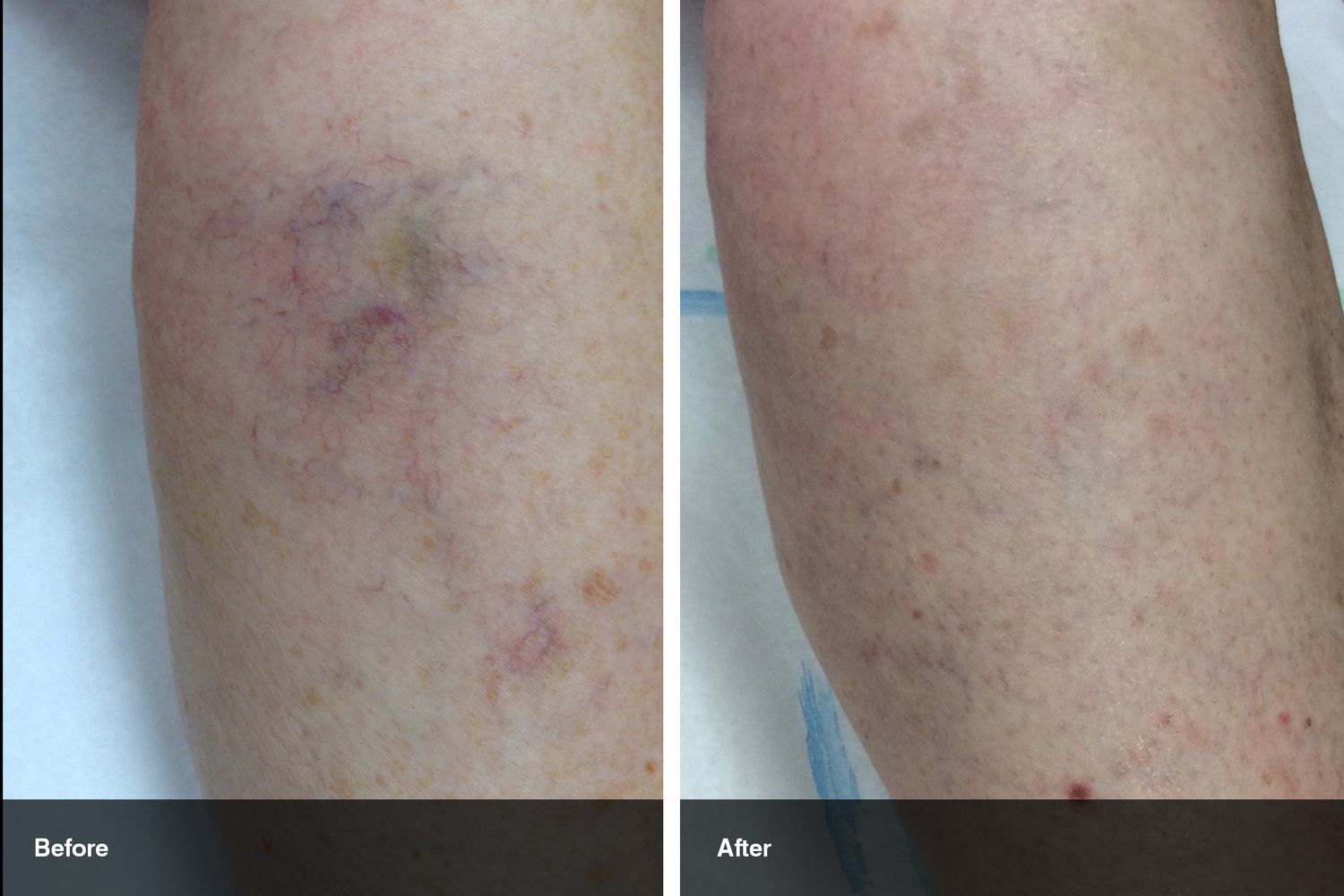 spider veins before after midwest vein and laser dayton 0