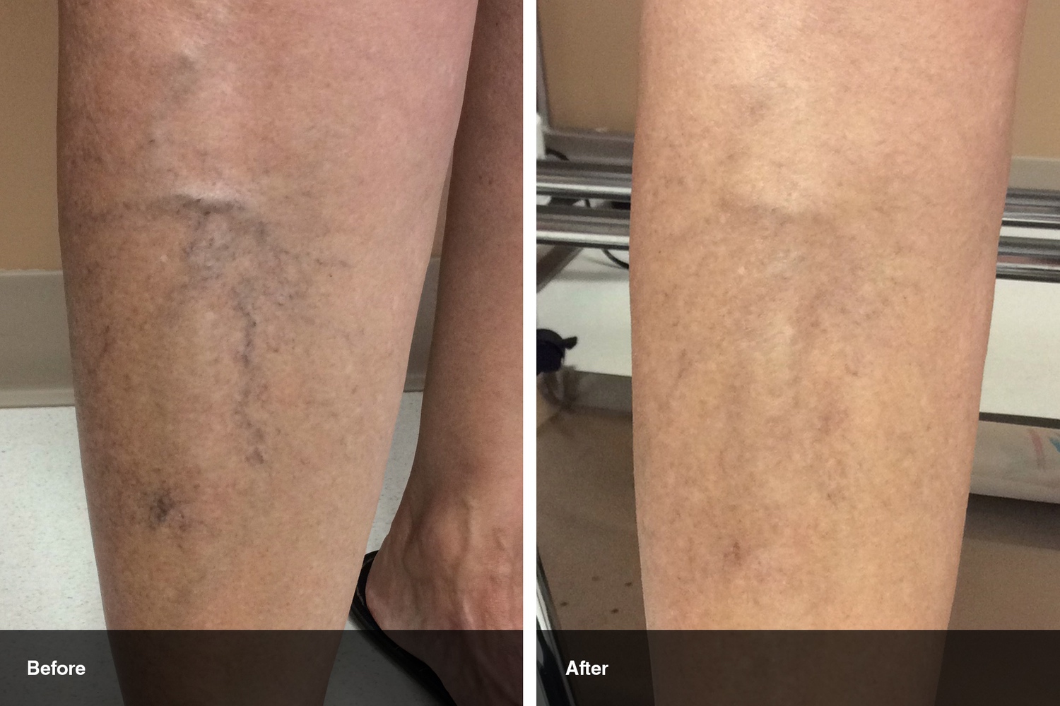 spider veins before after midwest vein and laser dayton 1