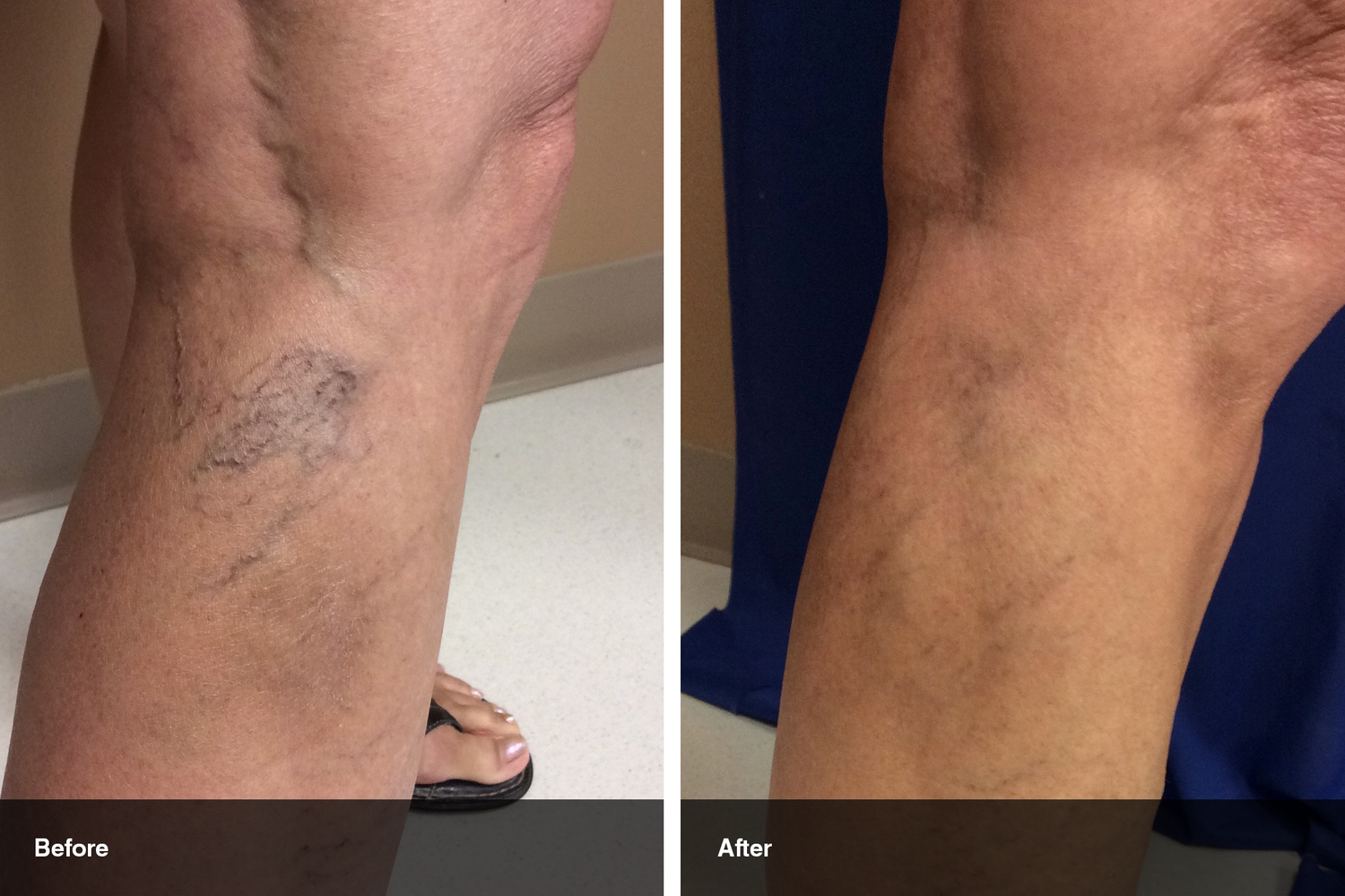 spider veins before after midwest vein and laser dayton 2