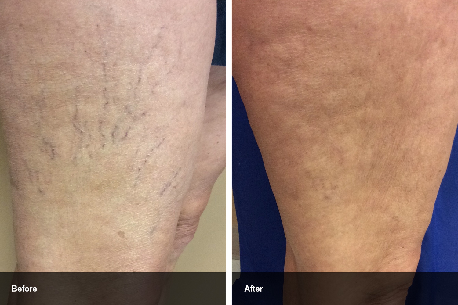 spider veins before after midwest vein and laser dayton 3