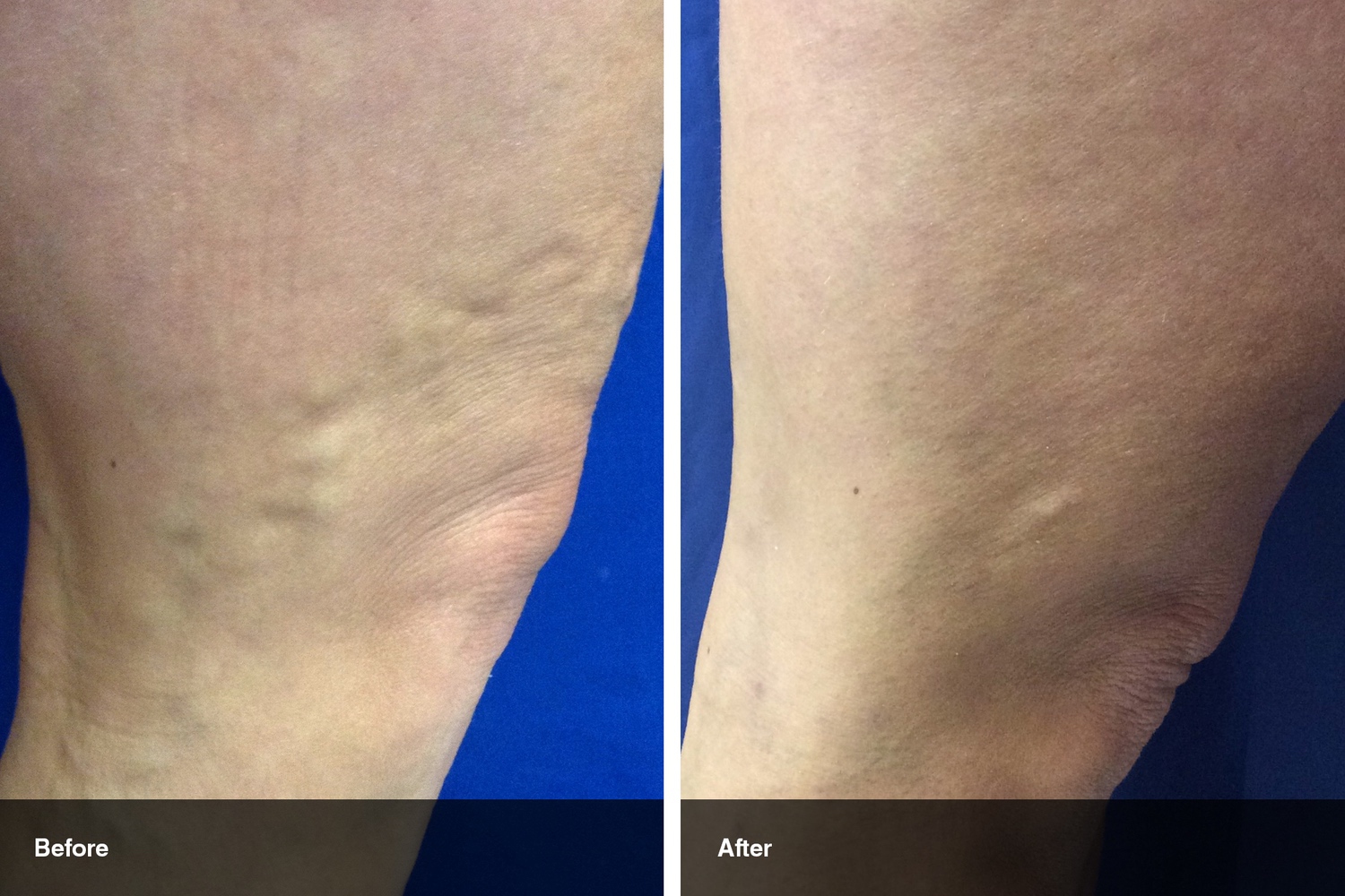 varicose veins before after midwest vein and laser dayton 0