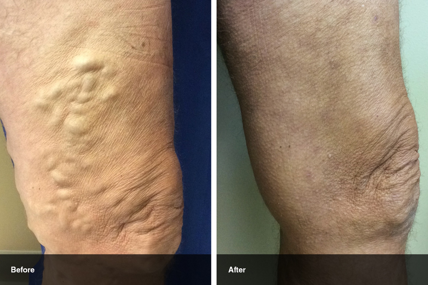 varicose veins before after midwest vein and laser dayton 1