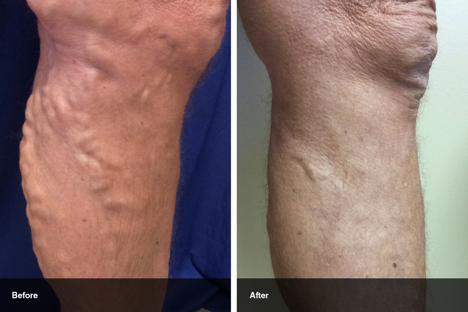 varicose veins before after midwest vein and laser dayton 2