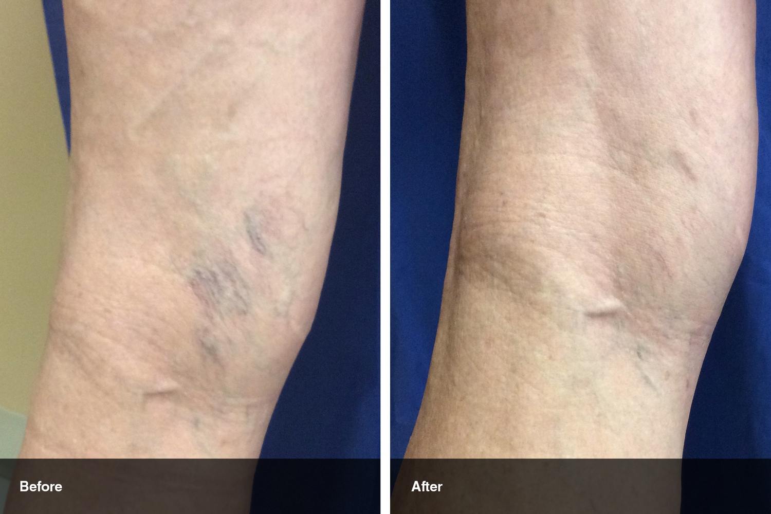 varicose veins before after midwest vein and laser dayton 3