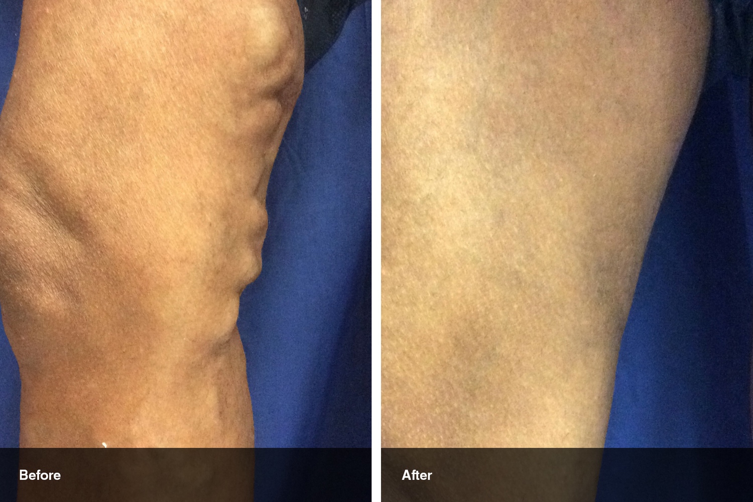 varicose veins before after midwest vein and laser dayton 4