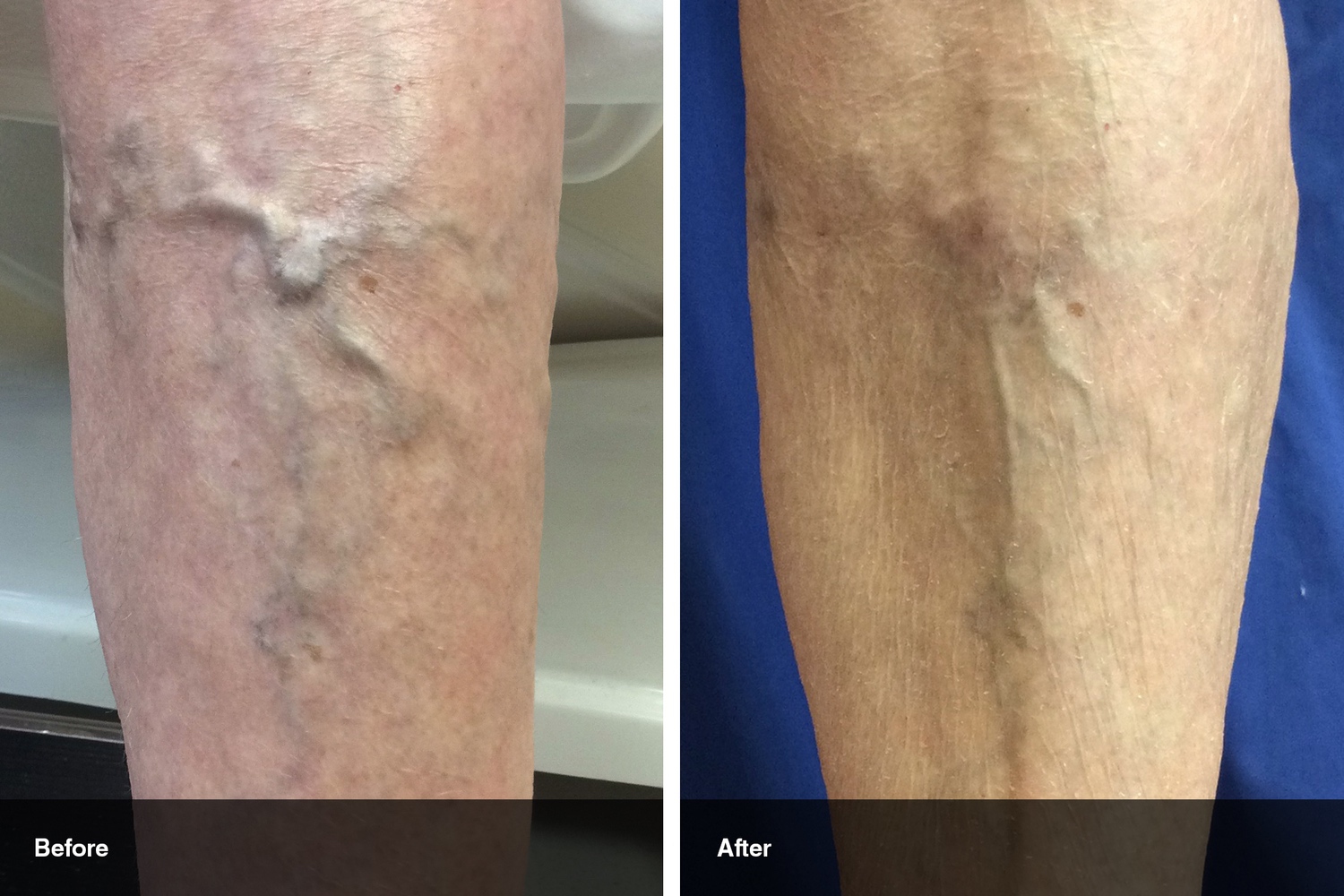 varicose veins before after midwest vein and laser dayton 5