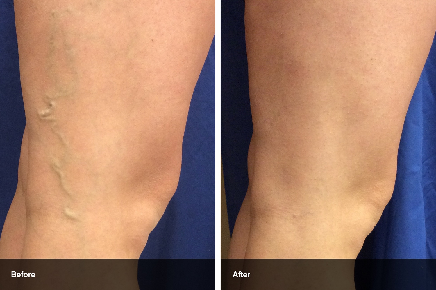 varicose veins before after midwest vein and laser dayton 6