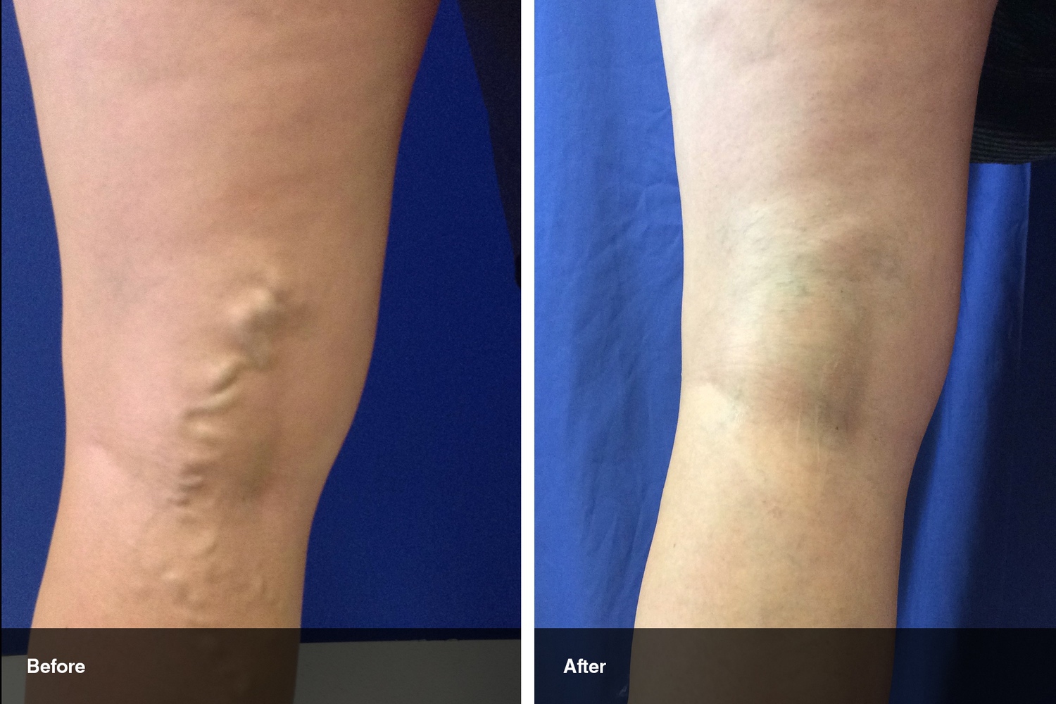 varicose veins before after midwest vein and laser dayton 7