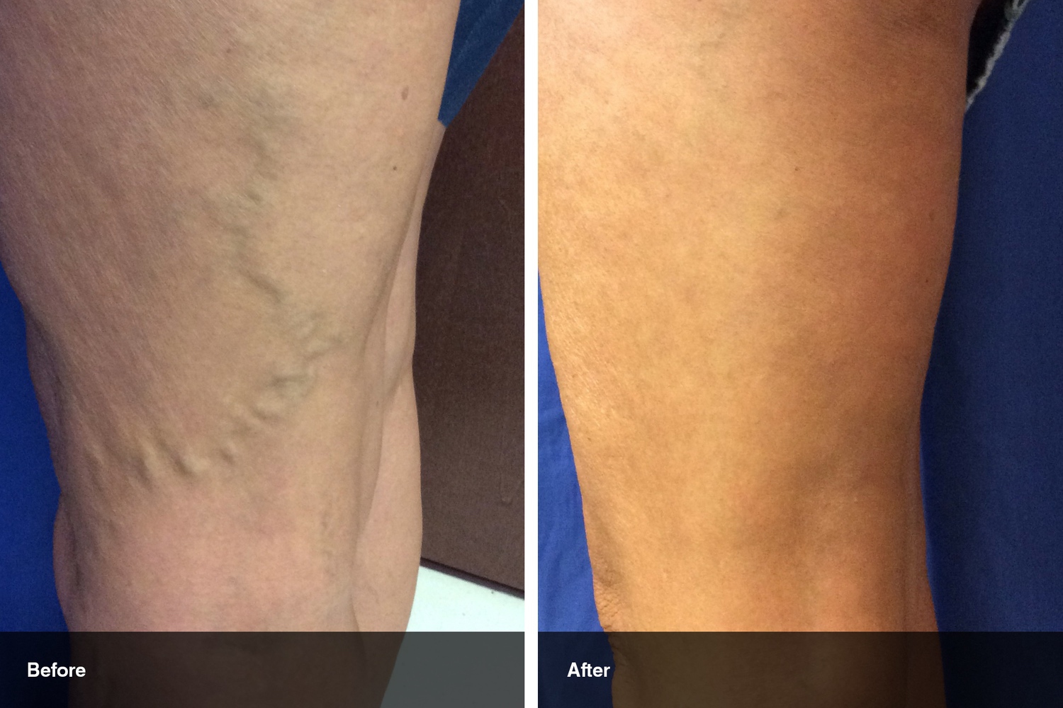 varicose veins before after midwest vein and laser dayton 8