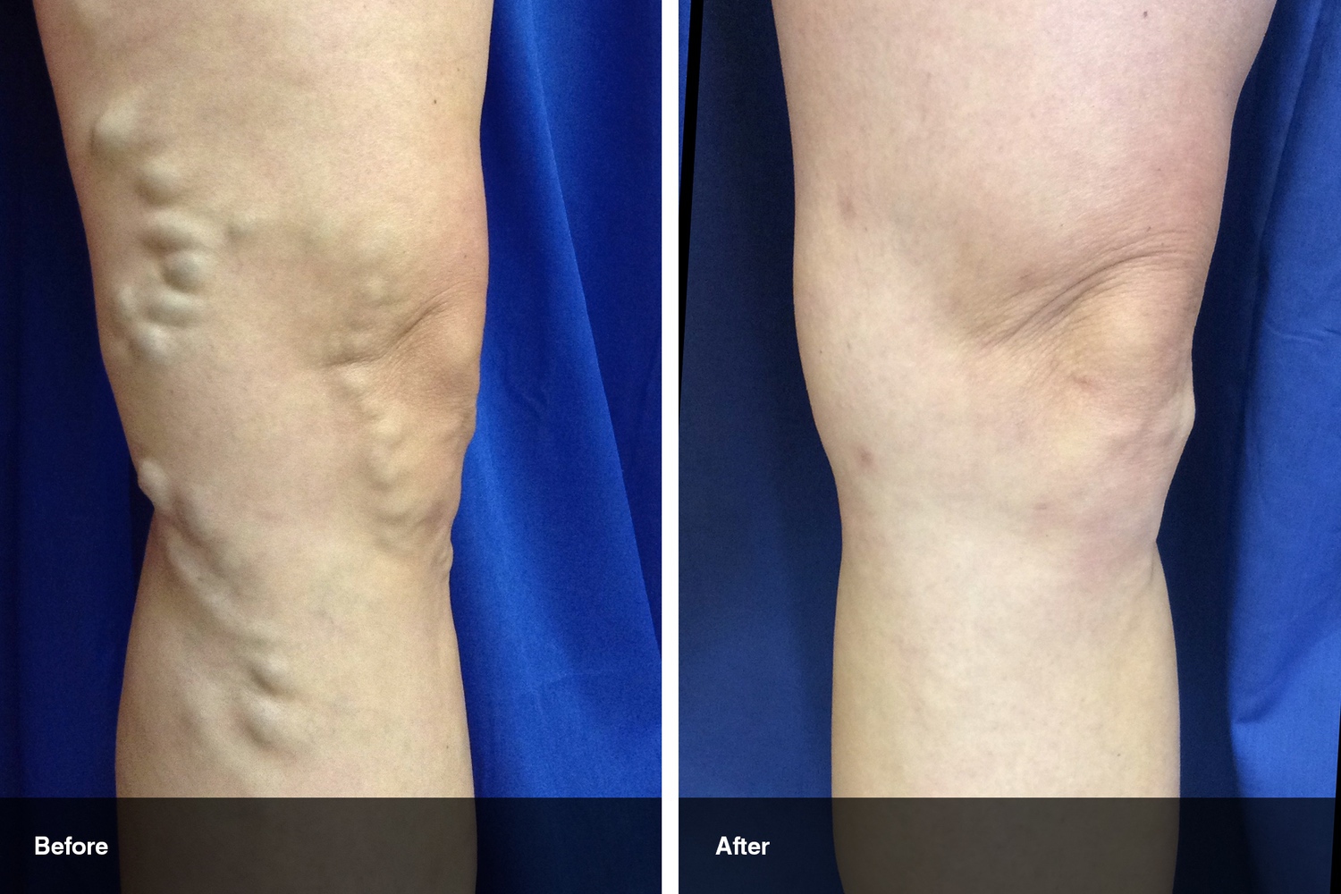 varicose veins before after midwest vein and laser dayton 9