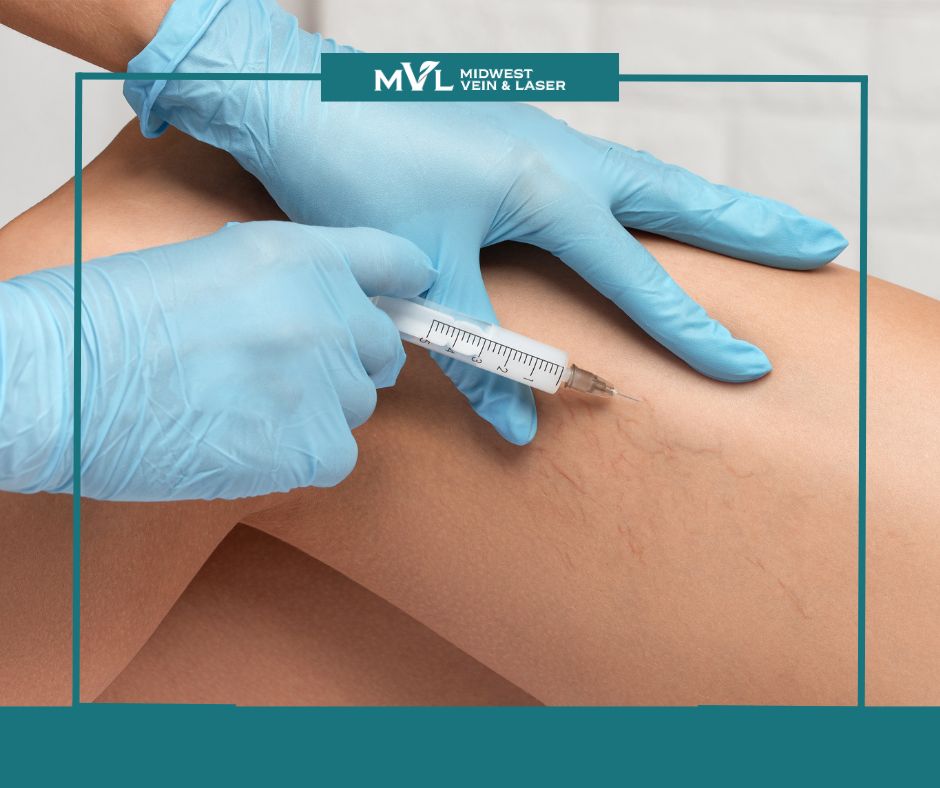 Sclerotherapy spider vein treatment post Midwest Vein and Laser 2
