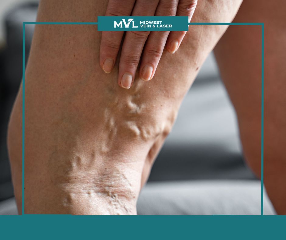 Varicose Veins post Midwest Vein and Laser 2
