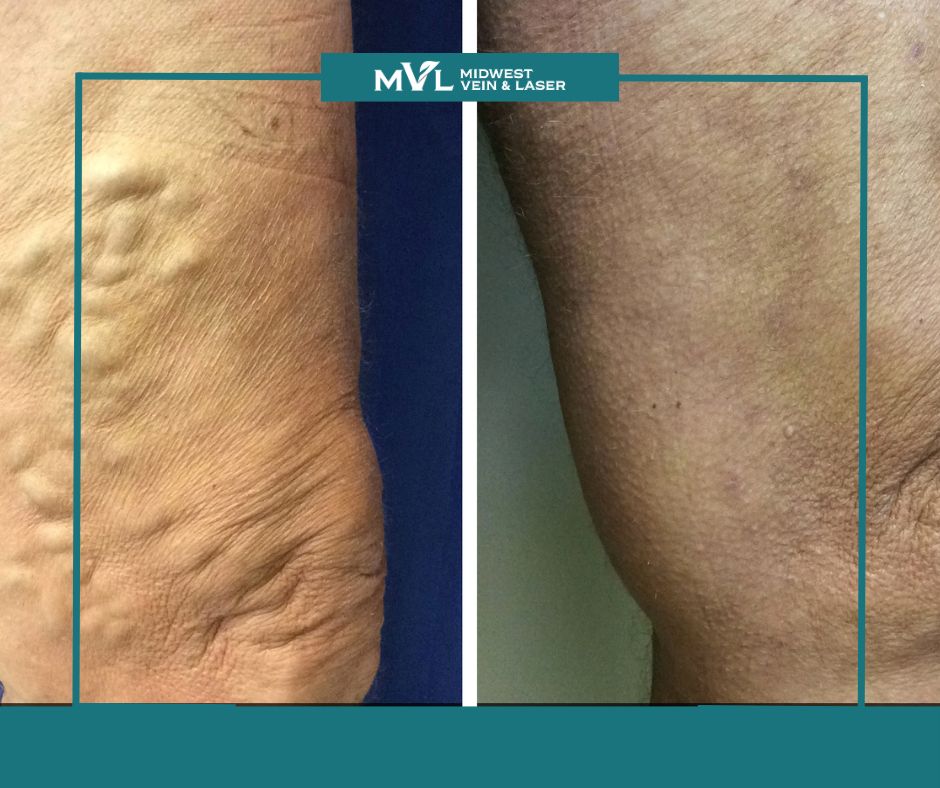 Varithena for varicose veins post Midwest Vein and Laser 2