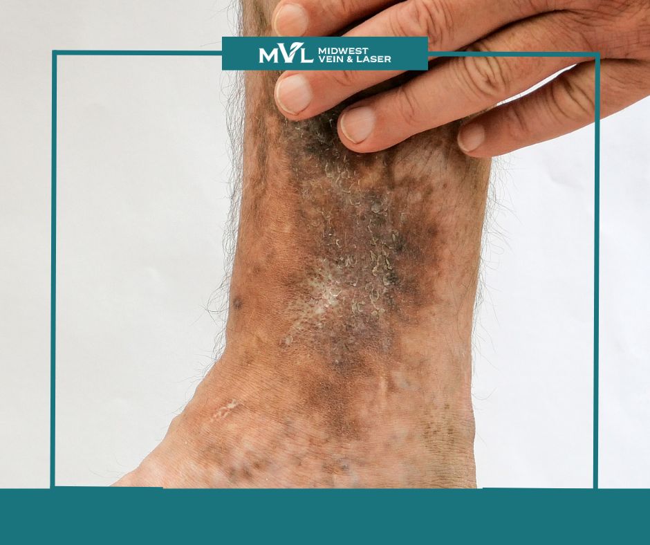 Venous stasis ulcer post Midwest Vein and Laser 2